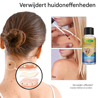 LS |  Moedervlekken & Wratten verwijderaar