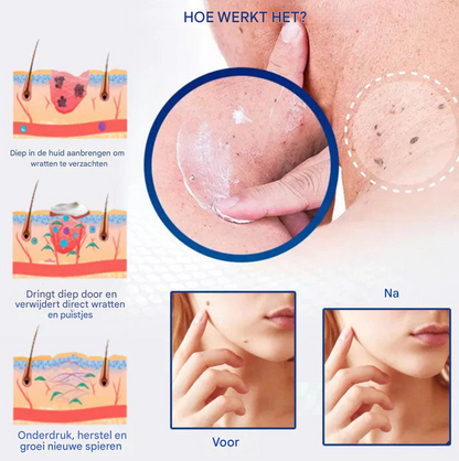 LS | Fast active wratverwijder crème