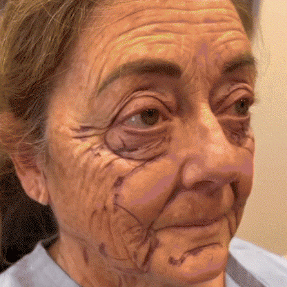 LS | 7-Daagse Bijengif Huidbehandeling 1+1 gratis