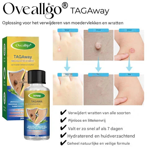 LS |  Moedervlekken & Wratten verwijderaar