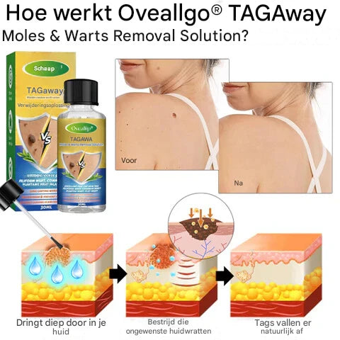 LS |  Moedervlekken & Wratten verwijderaar