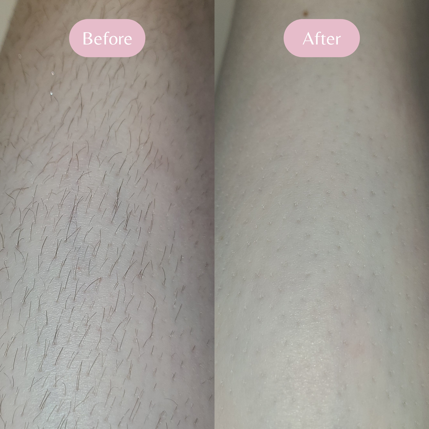 LS | Magic-touch Haar Verwijderaar