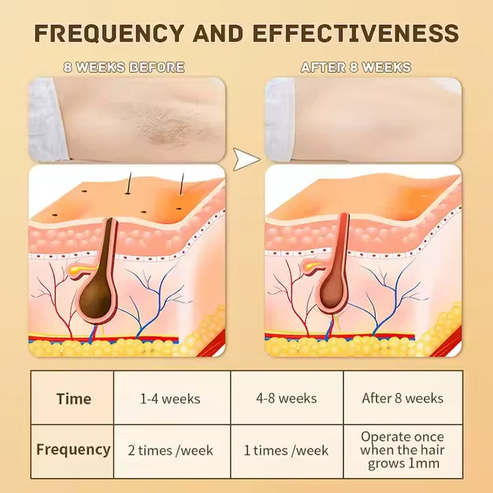 LS | IPL Laser Ontharing