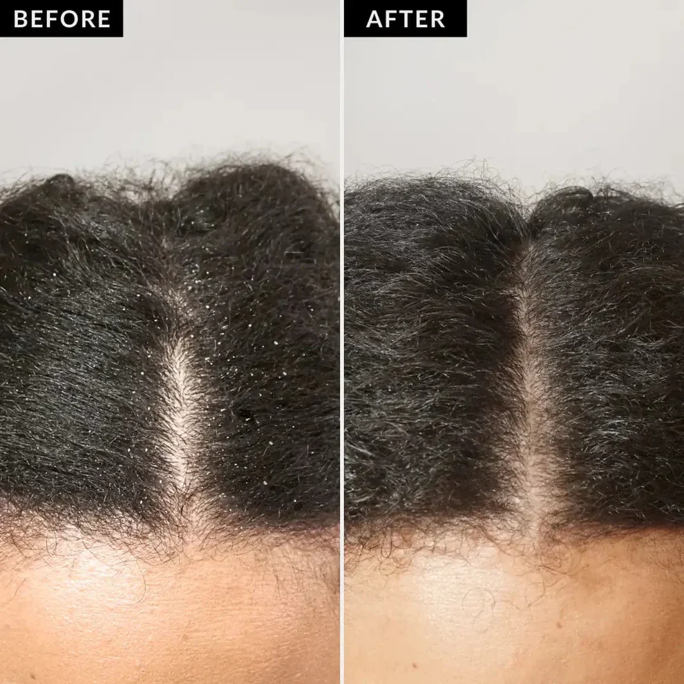 LS | Hoofdhuid detox kam