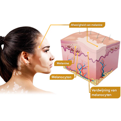 LS | Bijengif Vitiligo Behandelcrème