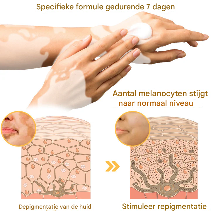 LS | Bijengif Vitiligo Behandelcrème
