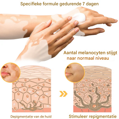 LS | Bijengif Vitiligo Behandelcrème